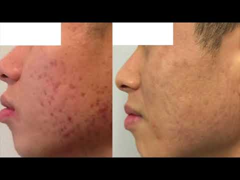How To Clear Up Severe Acne