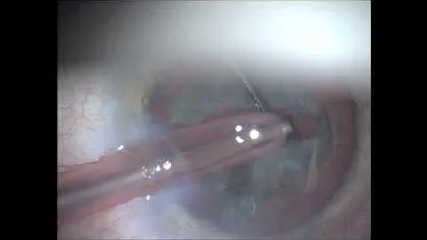 Cataract surgery 2