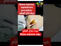 خزعة نخاع العظم Bone Marrow Aspiration Shorts خزعة نخاع العظم Bone Marrow Aspiration Shorts
