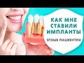 Имплантация зубов или съёмные зубные протезы. Отзыв пациентки об имплантации зубов | Дентал ТВ