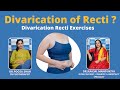 Divarication of recti  divarication recti exercises  drkaajal mangukiya  drpooja shah