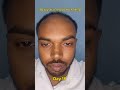 Day 18 | 180 days hair regrowth challenge #hairfallsolution #hairstyle