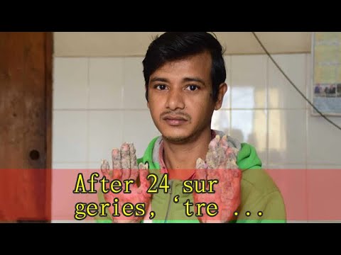 After 24 surgeries, ‘tree man’ relapses in Bangladesh