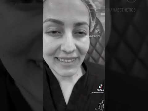 Video thumbnail: 5D Nose Approach- 10 months after- NO · Dr. Anil Shah