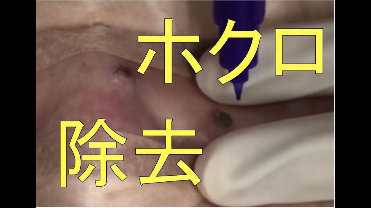 ほくろ除去切開法 閲覧注意 手術動画 Excision Of Mole Youtube