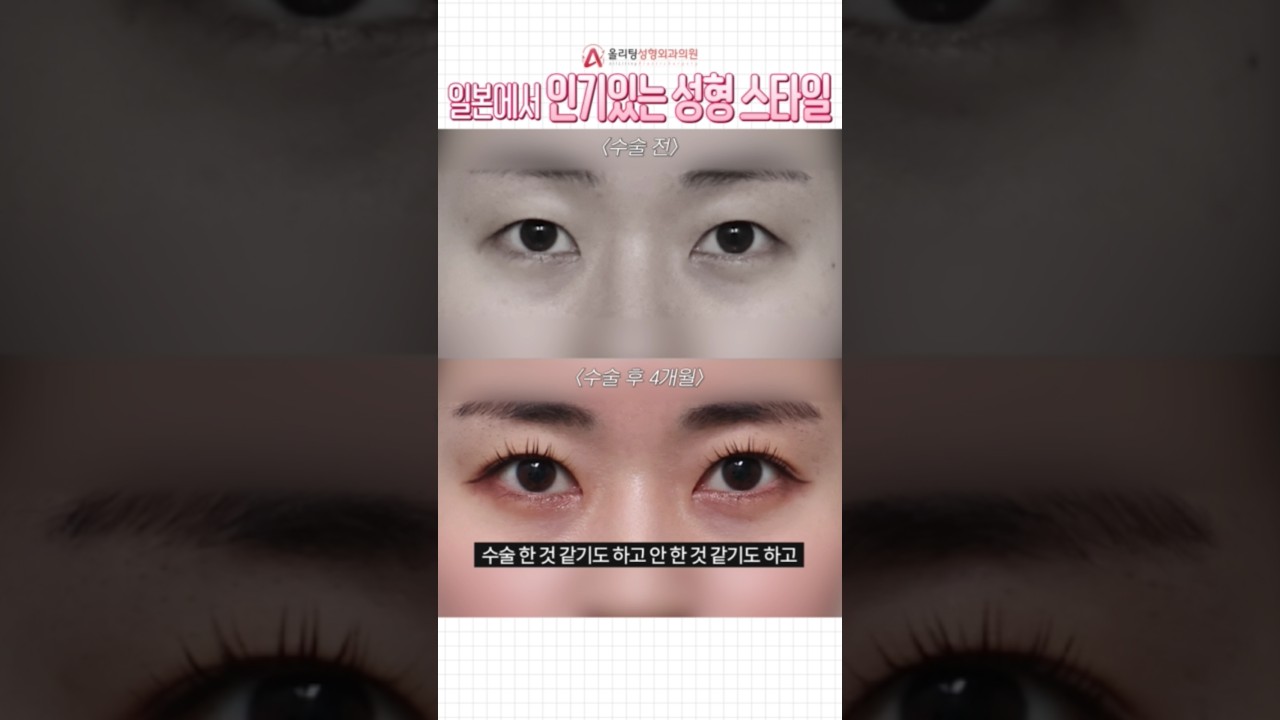 [Олитинг гоо сайхны мэс заслын эмнэлэг] Япон хүн Солонгост гоо сайхны мэс засал хийлгэсний дараа гайхсан шалтгаан нь юу вэ? #гоосайхнымэсзаслынзөвлөгөө #шортс #сэдэв