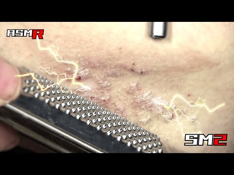 【眠くなっちゃうアトピー性皮膚炎ASMR】痒すぎる膝の脇のぶつぶつをチーズ削り器で掻く音/癒し/リラックス効果/睡眠導入/マッサージ