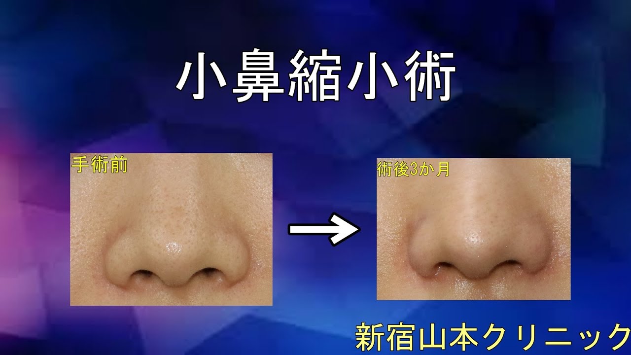 小鼻縮小 鼻翼縮小 小鼻縮小のプチ整形 小鼻をほんのちょっと小さくする症例 鼻の他院修正手術 鼻の他院修正手術 東京新宿の山本クリニック 小鼻縮小 鼻翼縮小 小鼻縮小のプチ整形 小鼻をほんのちょっと小さくする症例 鼻の他院修正手術 鼻の他院修正手術 東京新宿の山本クリニック