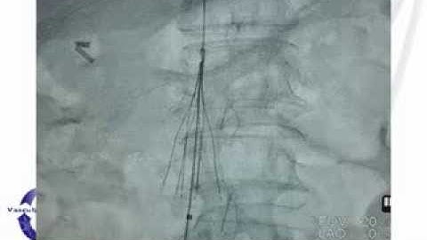 OptionELITE Over-The-Wire IVC Filter Delivery Technique