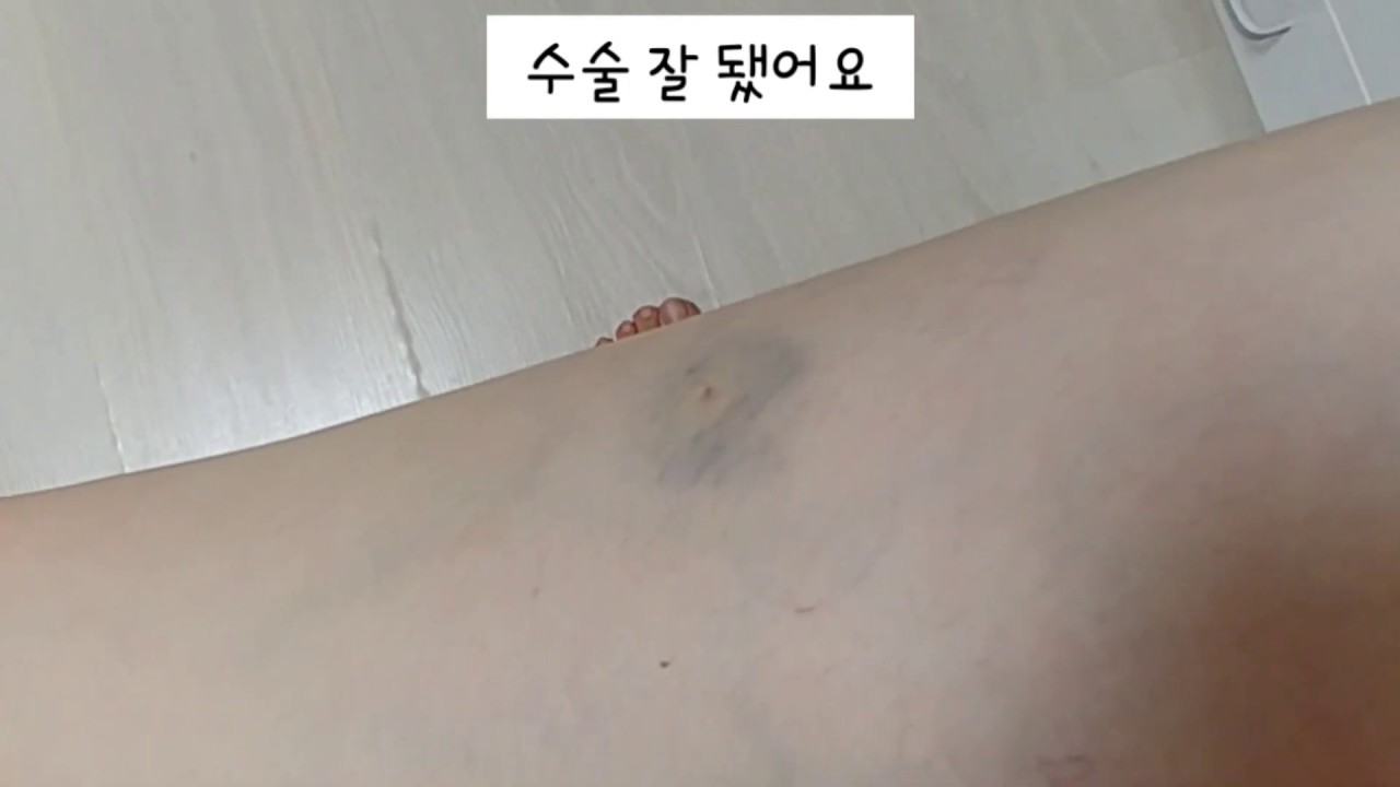 [하지정맥류 수술후기]  신의료기법 클라리베인 시술하고 실비보험으로 수술비 100% 환급받기