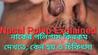 What is Nasal Polyp - Looks, Causes & Treatment