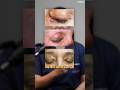 Yellow Patches Around Eyes Get Your Cholesterol Checked Yelloweyes Eyes Eyecare 