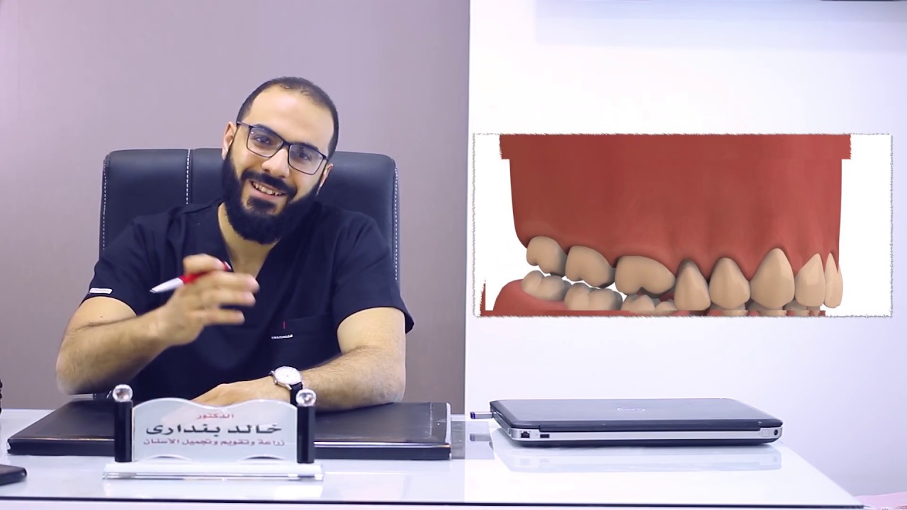 الفرق بين التركيبات الثابتة و زراعة الأسنان  -  د/خالد بنداري