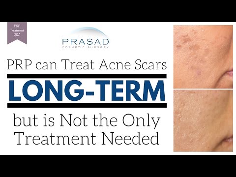 PRP can be Effective for Acne Scar Treatment When Combined with Other Procedures