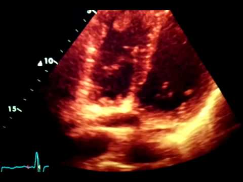 RIGHT VENTRICLE APICAL THROMBUS - YouTube