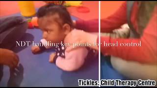 Neurodevelopment Treatment (NDT) for Dystonic Cerebral Palsy