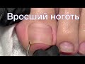 Вросший ноготь, подногтевой мозоль. Ingrown nail, brow callus.