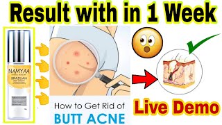 Buttock acne, pimples, marks, scars ...