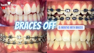 How long  braces take? Braces off 15 months - Tooth Time Family Dentistry New Braunfels