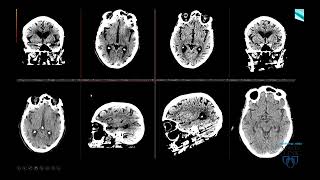 Imaging Acute Stroke: A Comprehensive Review for Clinical Practice - Course Sample Wealth