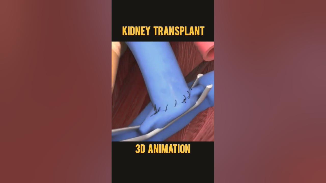 kidney transplant । 3d animation #shorts #medical #3d #humanbody #3danimation #surgery #shortvideo kidney transplant । 3d animation #shorts #medical #3d #humanbody #3danimation #surgery #shortvideo
