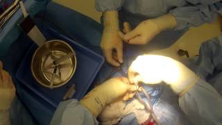 Collecting cord blood stem cells at cesarean section