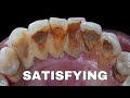 55 yo. Female&#39;s Teeth | Scaling | Satisfying | Dentist | Dokter Gigi Tri Putra