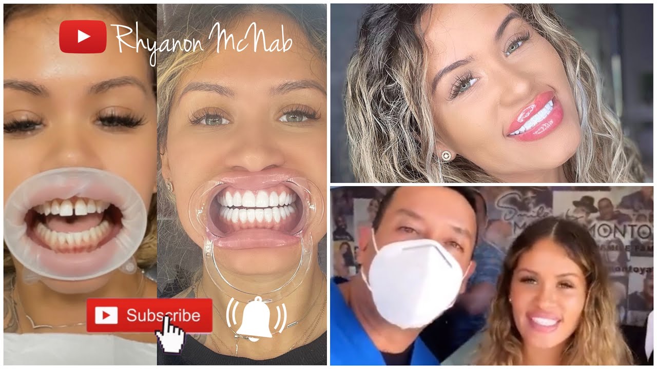 Veneer experience Dr. Mario Montoya in Colombia fixed my teeth! YouTube
