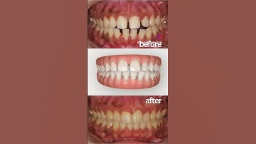 Gap Teeth correction with Invisalign #invisalign #invisalignbeforeandafter #transformation #smile