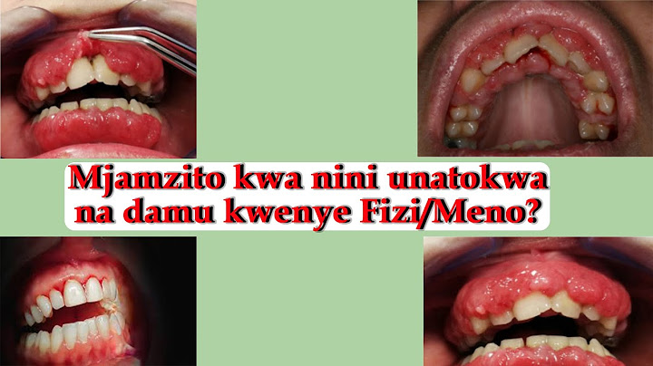 Mjamzito kuumwa Meno! | Mjamzito Kutokwa na Damu kwenye Meno (Je Visababishi na Vizuizi ni vipi???)