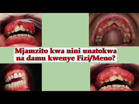 Video: Njia 3 za Kuepuka Kuumiza Ufizi Wako
