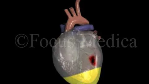 Pericardial effusion - Heart - DayDayNews