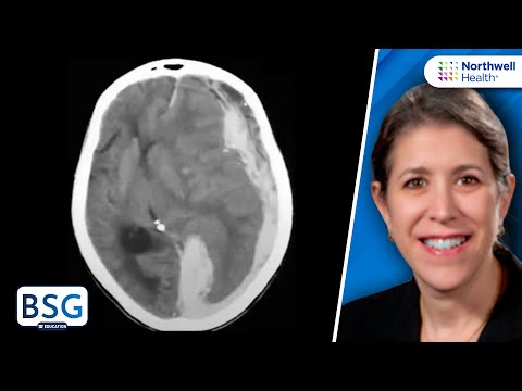 Video: Craniectomy Decompressive Untuk Stroke Iskemia Akut