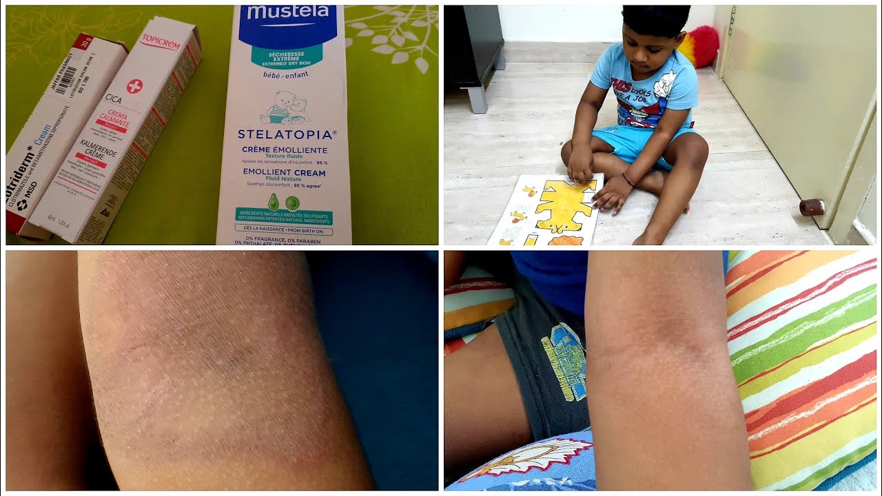 My Son's ATOPIC DERMATITIS Rash | How We Cured Our Son's Extreme Rash ...