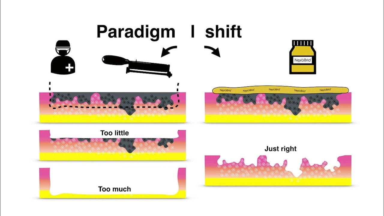 Enzymatic Debridement of Burns with Nexobrid A patient Case Study