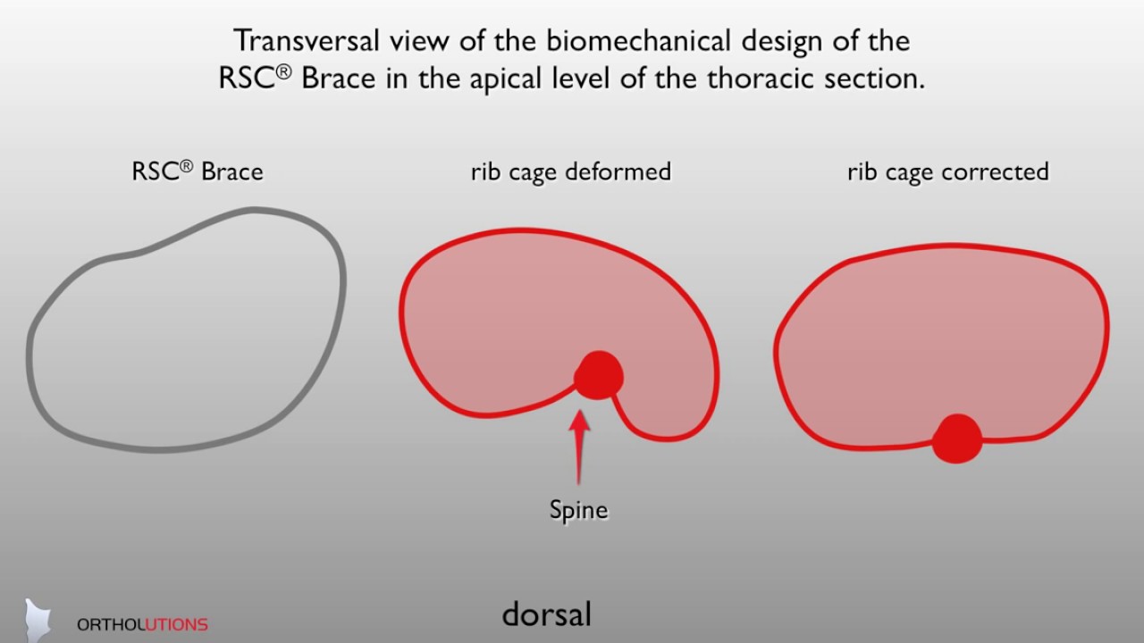 Skoliose Korsett RSC® Brace- Transversal view of the thoracic section- spinal orthoses biomechanics