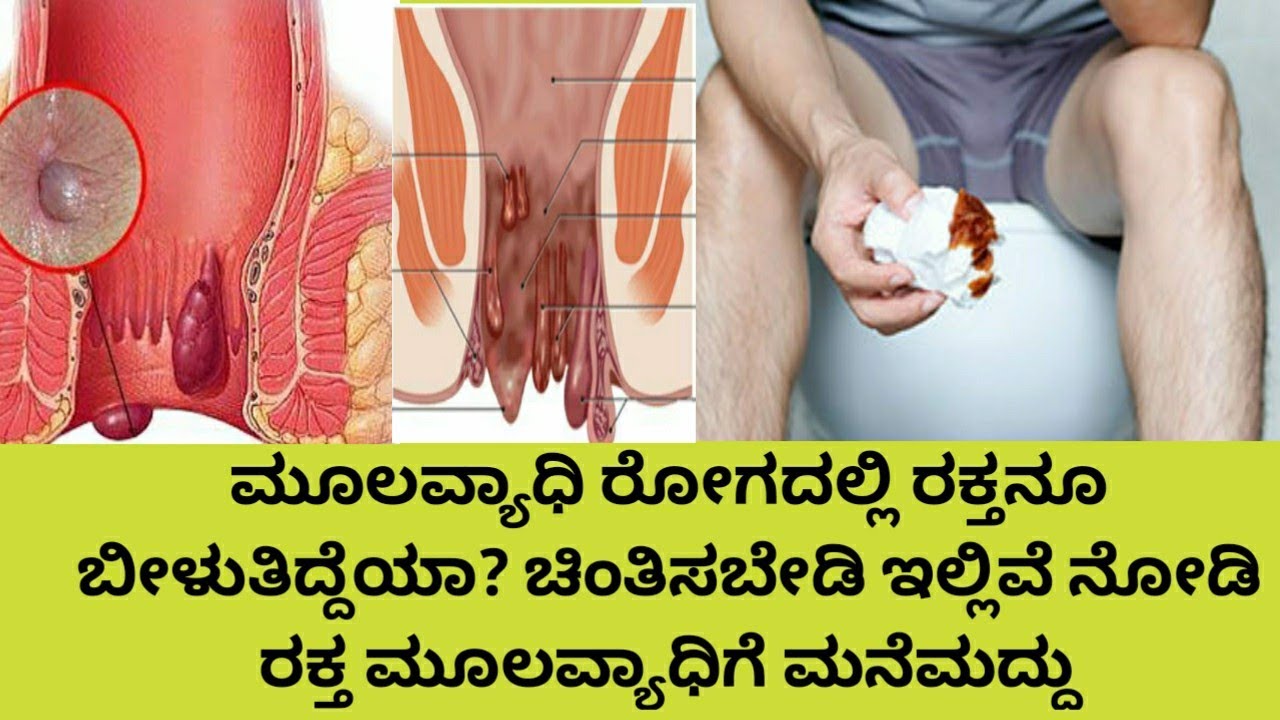 ಮೂಲವ್ಯಾಧಿ ರೋಗದಲ್ಲಿ ರಕ್ತನೂ ಬೀಳುತಿದ್ದೆಯಾ? ಚಿಂತಿಸಬೇಡಿ ಇಲ್ಲಿವೆ ನೋಡಿ ರಕ್ತ ಮೂಲವ್ಯಾಧಿಗೆ ಮನೆಮದ್ದು|cure piles - YouTube