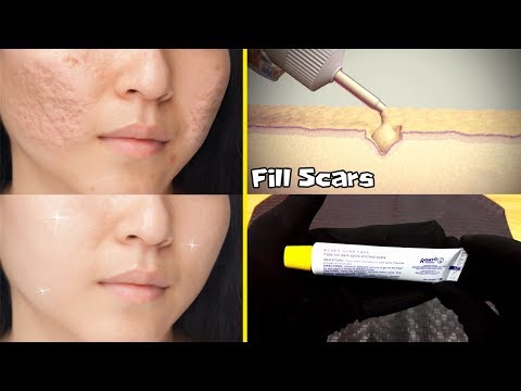 GET RID OF ACNE SCARS: MEDICATED GEL ALSO EFFECTED ON PIMPLES URDU HINDI