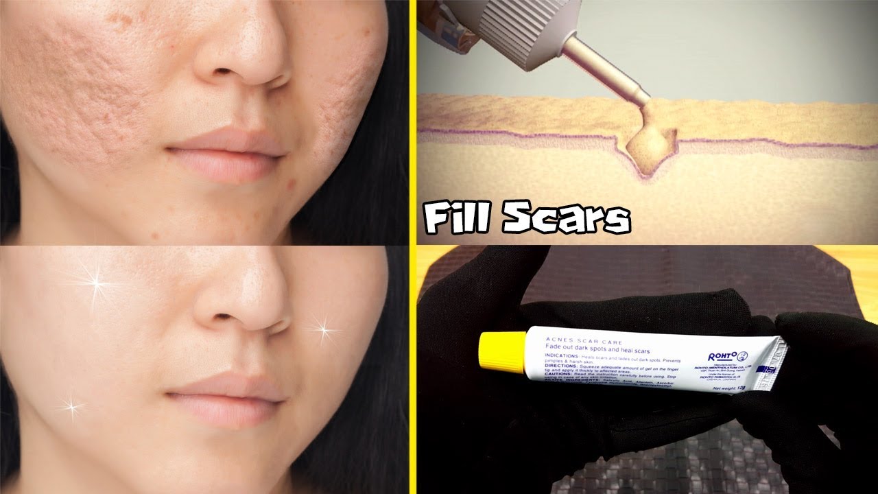 GET RID OF ACNE SCARS MEDICATED GEL ALSO EFFECTED ON PIMPLES URDU 