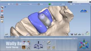 Planscan emax adhesion bridge