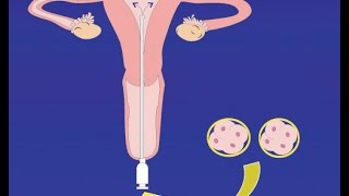 Embriyo Transferi Nasıl Yapılır? - Op. Dr. Emre Karatekelioğlu
