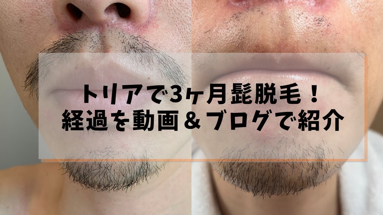 【トリアの体験談】髭脱毛の経過を動画でまとめてみた! YouTube 【トリアの体験談】髭脱毛の経過を動画でまとめてみた! YouTube