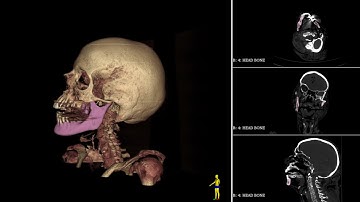 3D Slicer Jawbreaker Animation of the Mandible