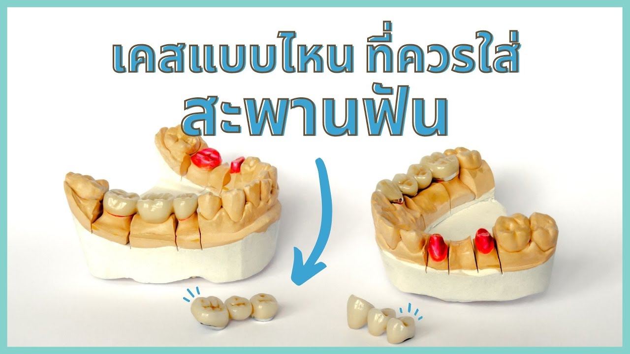สะพานฟันหรือฟันปลอมติดแน่นชนิดอื่น เลือกแบบไหนดี?