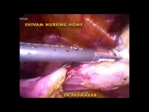 Total Laparoscopic Hysterectomy Full Video Using Simple Bipolar