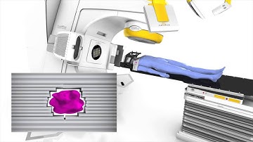 What is stereotactic radiosurgery? Dr Andrew See