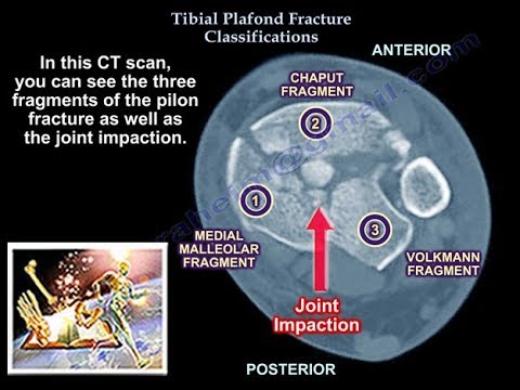 Tibial Plafond Fracture Classification Everything You Need To Know Dr Nabil Ebraheim