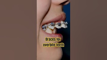 Braces for overbite teeth transformation #braces #orthodontist #dentist