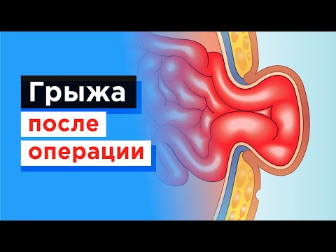 Удаление послеоперационной грыжи бесплатно по полису ОМС