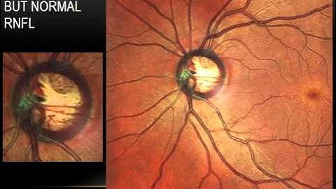 Multicolor + OCT: Complementary Tools in Glaucoma Management